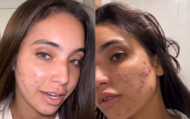 Vanessa Lopes mostra rosto sem filtro e maquiagem e exibe acnes