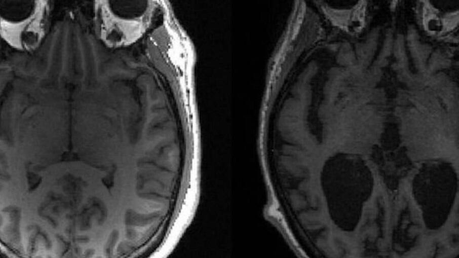 Imagem mostra cérebro saudável à esquerda e cérebro com Alzheimer à direita