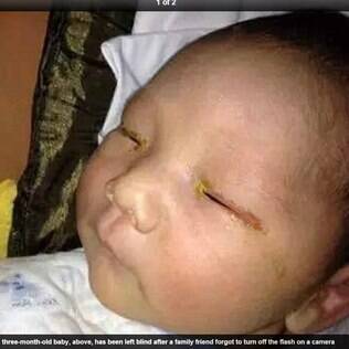 Bebê ficou cego do olho direito e perdeu parte da visão do esquerdo depois de uma foto com flash