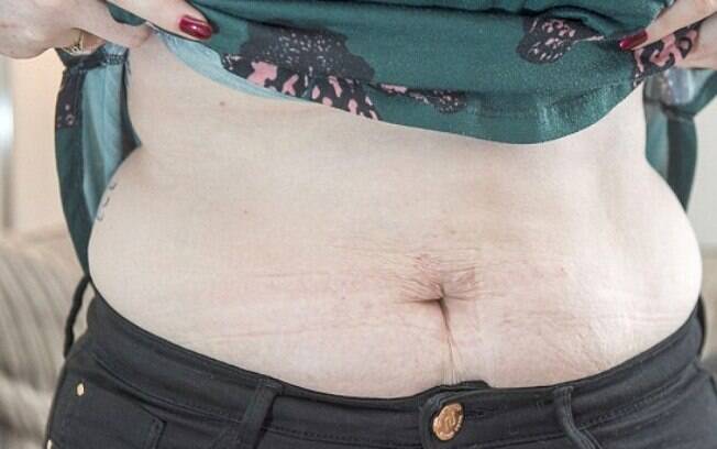 Barriga de Fiona um ano depois da gravidez Barriga de Fiona um ano depois da gravidez