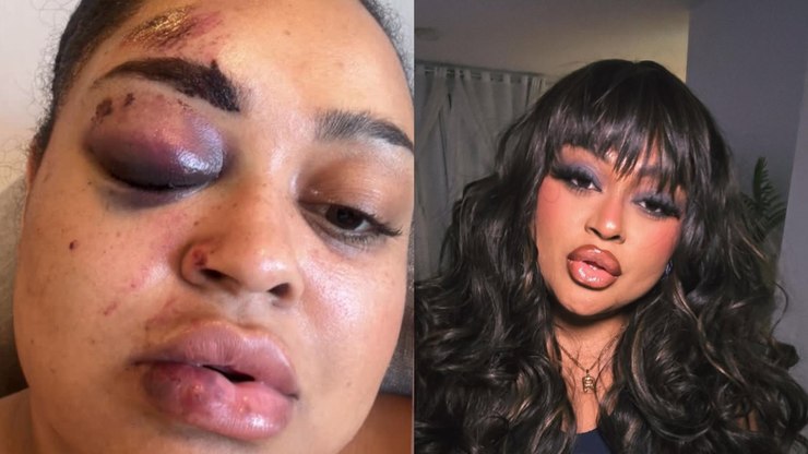 Ex-BBB Rízia Cerqueira revela acidente de moto e exibe hematomas