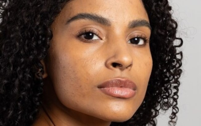 Mês da Acne: conheça os ativos mais eficazes para cuidar da pele acneica Mês da Acne: conheça os ativos mais eficazes para cuidar da pele acneica