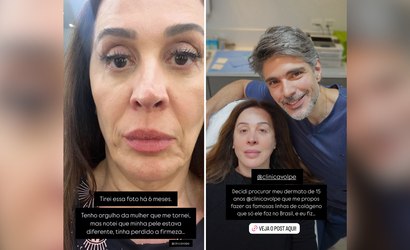 Claudia Raia exibe transformação após procedimento estético