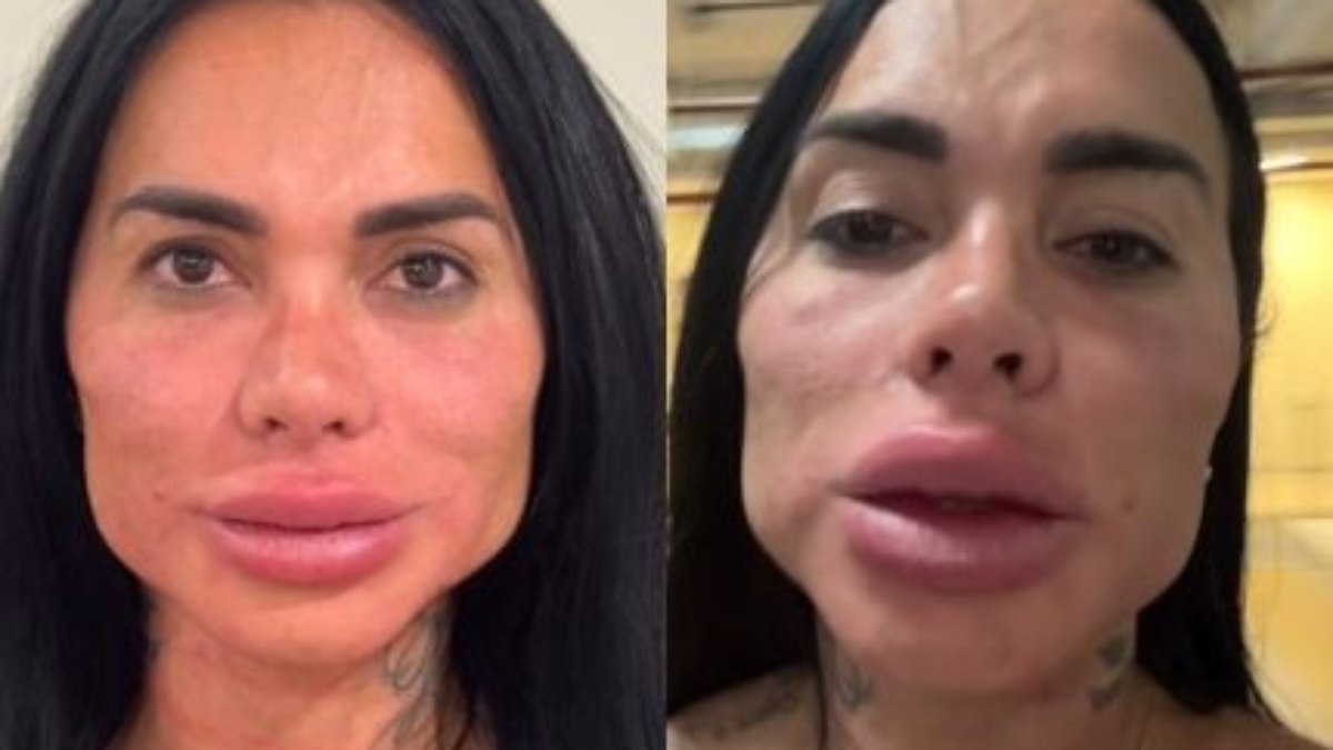 Kamila Simioni compartilhou como ficou o rosto após o procedimento em seu Instagram