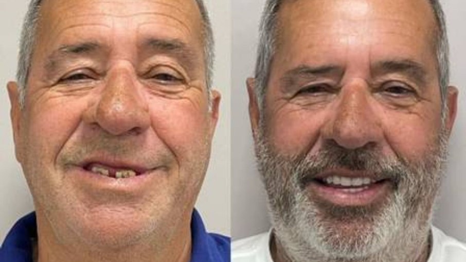 Luiz Carlos, pai de Ferrugem, no antes e depois do tratamento dentário