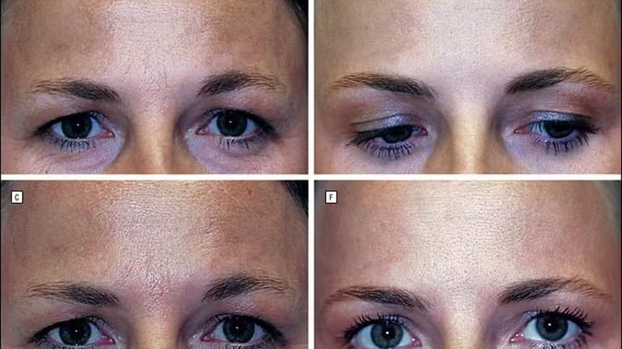 Estudo sobre botox compara gêmeas: uma aplicou toxina por 19 anos, outra não 