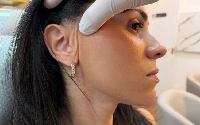 Lifting facial endoscópico dispensa cicatriz visível