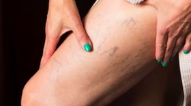 Varizes é coisa de mulher velha?