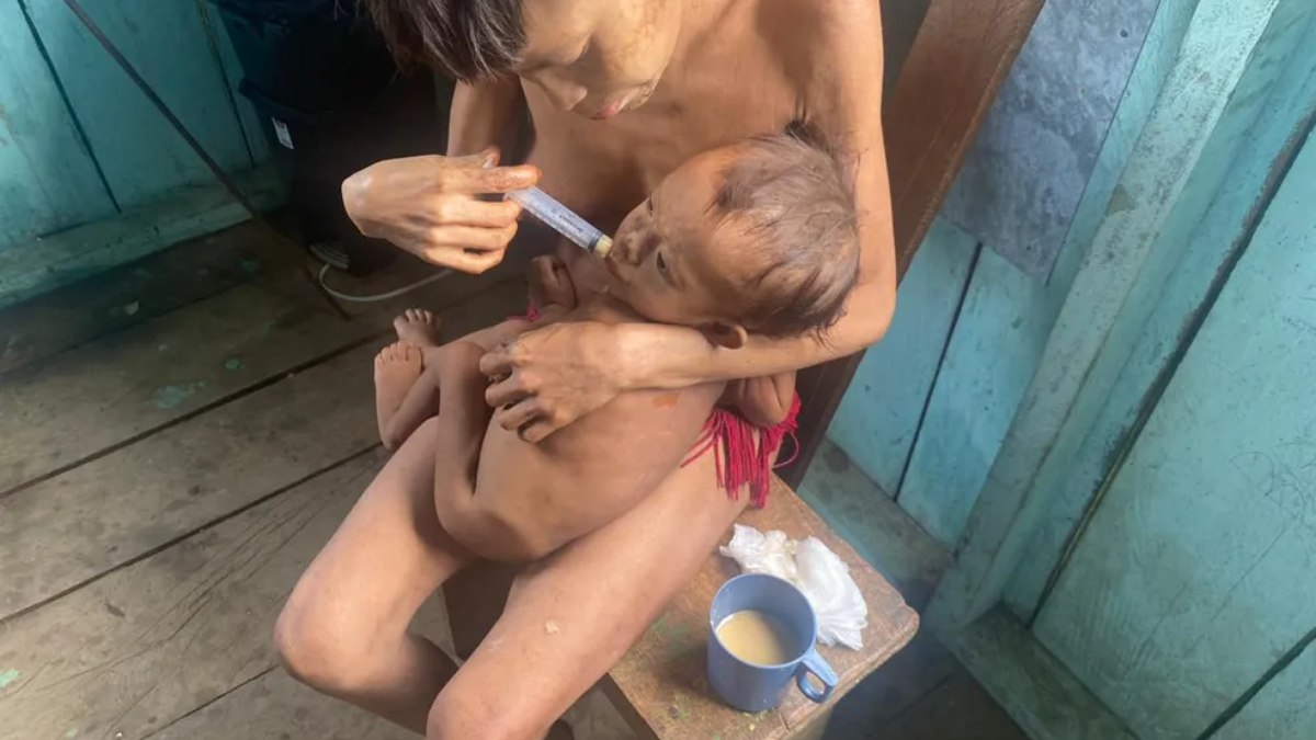 Crianças yanomami sofrem com desnutrição