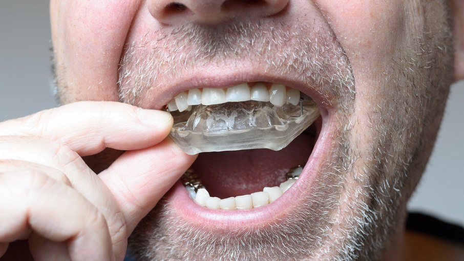 Placas de relaxamento feitas pelo dentista podem proteger os dentes e evitar o desgaste dental provocado pelo bruxismo Placas de relaxamento feitas pelo dentista podem proteger os dentes e evitar o desgaste dental provocado pelo bruxismo