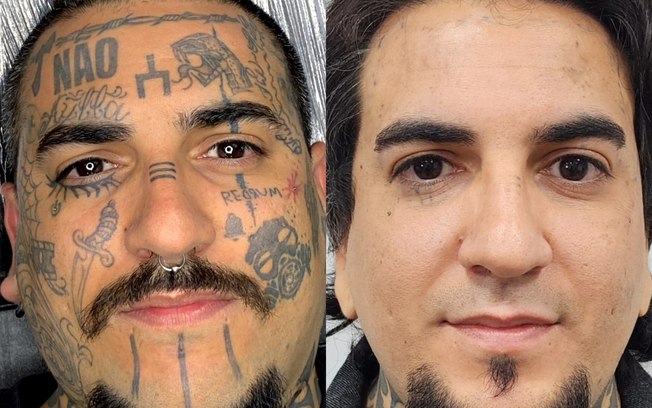 Remoção de tatuagem cresce e muda perfil de quem procura