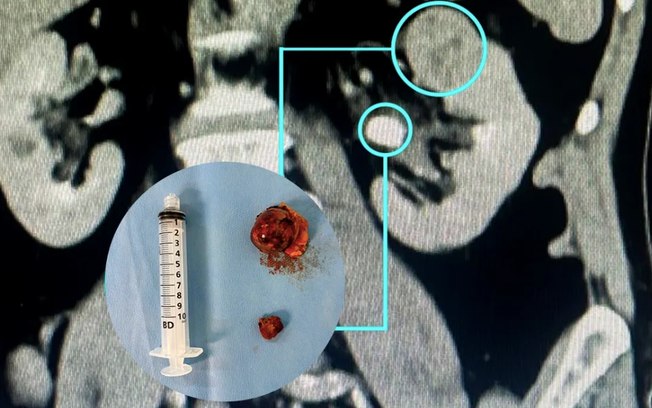 Nefrectomia robótica preserva rins com alta precisão