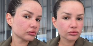 "Igual um baiacu": Juliette incha após tratamento inusitado