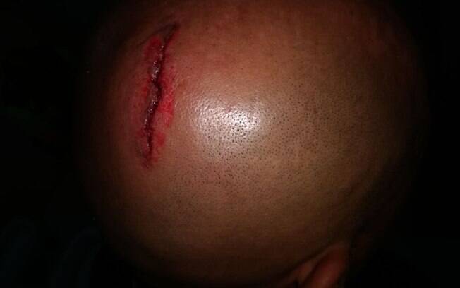 Um dos árbitros precisou levar dez pontos na cabeça após agressão dos torcedores