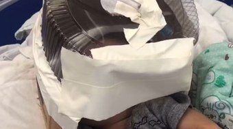 Hospital faz máscara de oxigênio com embalagem de bolo para bebê