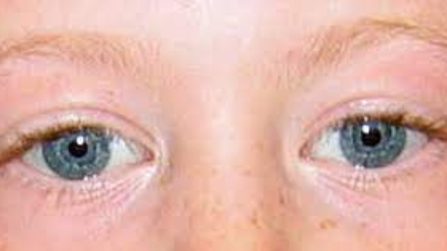 Olhos de pessoas com Síndrome de Williams apresentam padrão 'estrelado' na íris