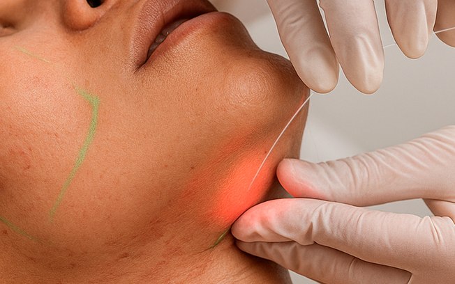 Laser subdérmico surge como alternativa à lipoaspiração