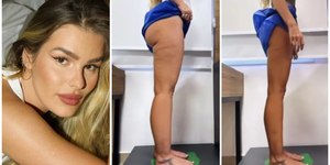 Lipedema: Yasmin Brunet traz visibilidade a doença após BBB
