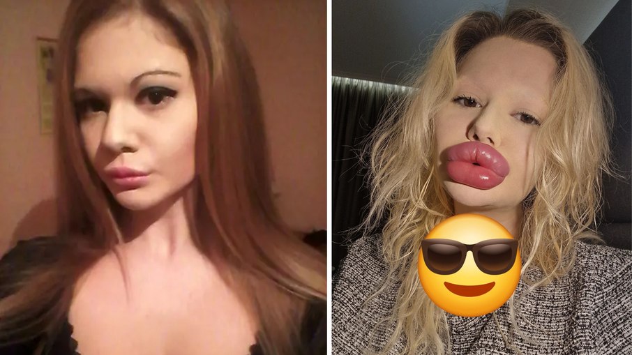 Antes e depois da mulher com lábios gigantes Antes e depois da mulher com lábios gigantes