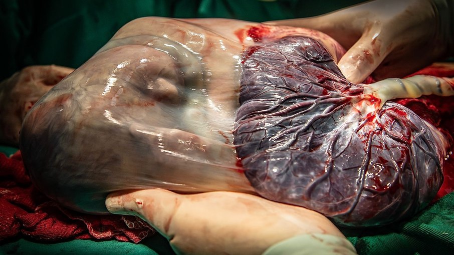 Mathias, segundo bebê empelicado fotografado por Ludmila Gusman.