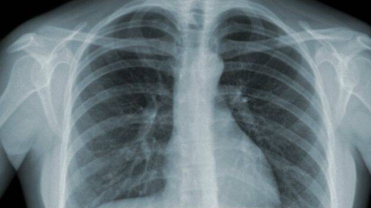 Combate à tuberculose é intensificado em Vinhedo