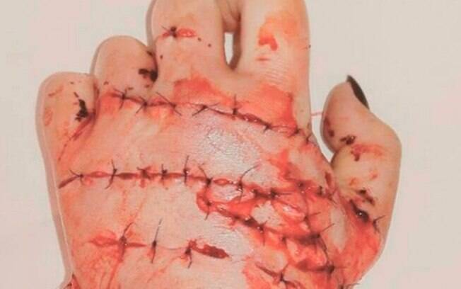 Mão da vítima depois de uma cirurgia de nove horas