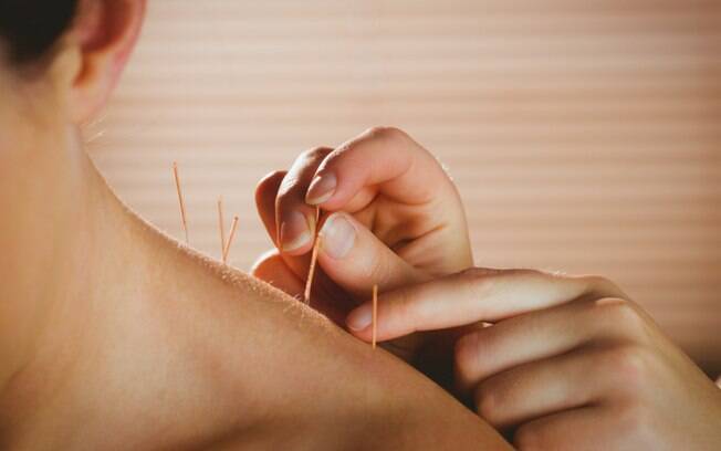 Conheça os benefícios da acupuntura para a saúde mental