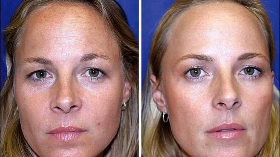 Estudo sobre botox compara gêmeas: uma aplicou toxina por 19 anos, outra não 