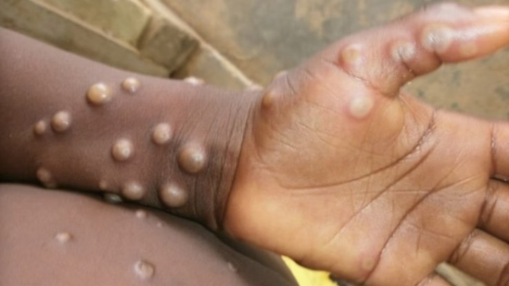 Porto Alegre confirma primeiro caso de Mpox em 2026
