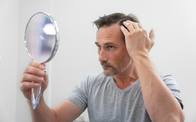 Tratamentos ampliam alternativas para calvície masculina