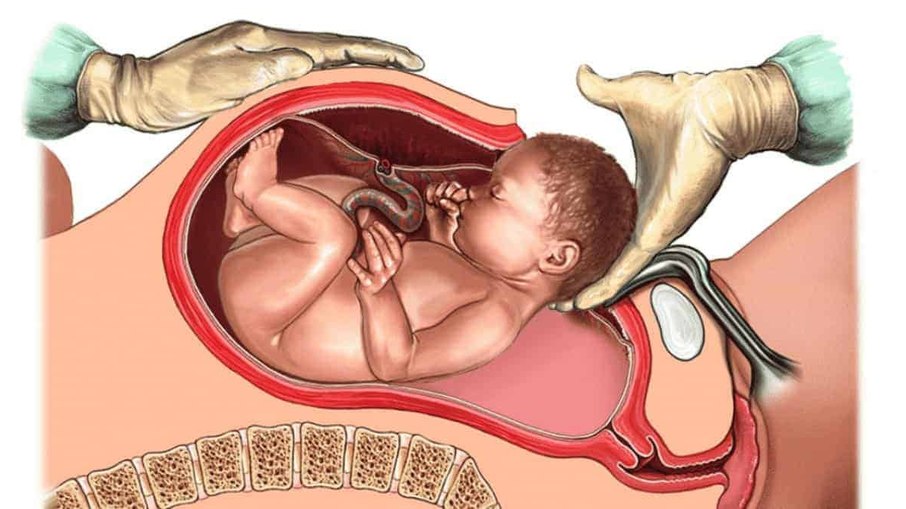 Ginecologista explica como funciona o parto cesárea