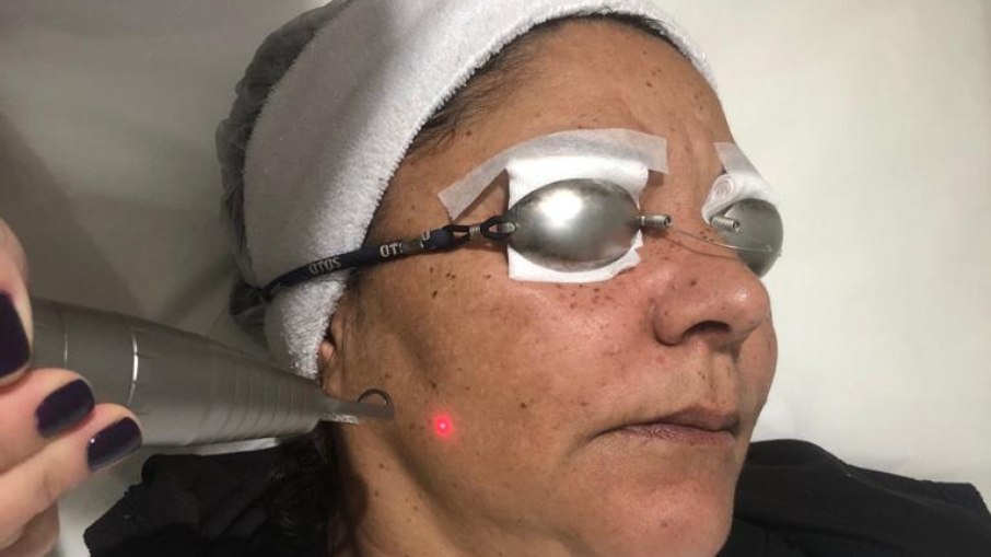 A aplicação é feita na área afetada pelo melasma 