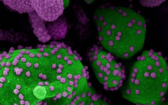 Micrografia eletrônica de varredura colorida de uma célula apoptótica (verde) fortemente infectada com partículas do vírus SARS-COV-2