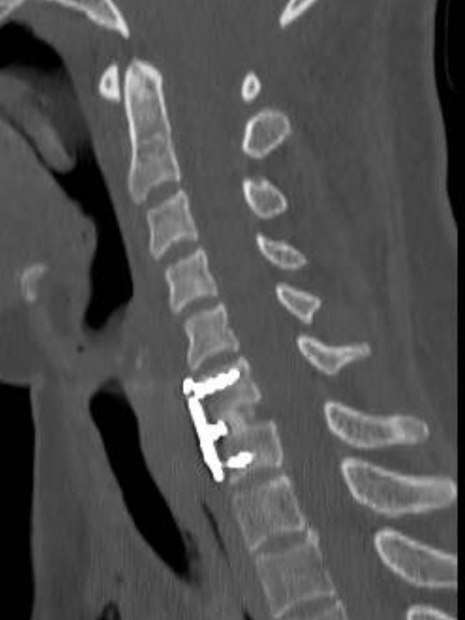 Ultrassom da coluna cervical