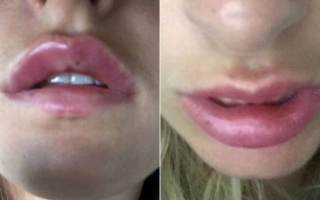 Tina pagou 75 libras por um preenchimento labial, realizado no salão de beleza que frequentava, e acabou se arrependendo