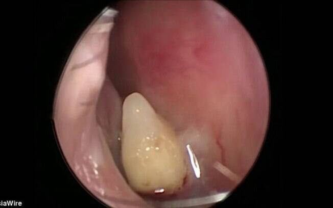 Além do caso do dente no cérebro, na China, uma mulher descobriu viver por anos com um dente dentro do nariz Além do caso do dente no cérebro, na China, uma mulher descobriu viver por anos com um dente dentro do nariz