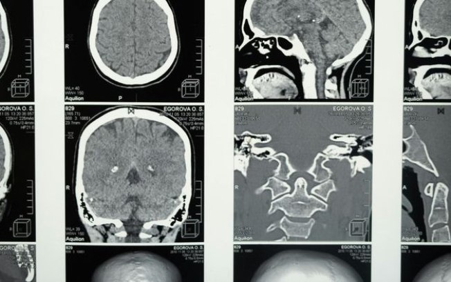 Implante cerebral faz pessoa com paralisia voltar a falar 2 idiomas