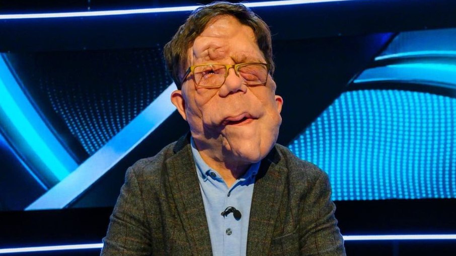 Adam Pearson tem uma rara condição chamada neurofibromatose