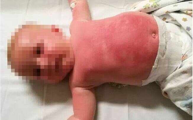 Jessie Swan postou a foto de seu bebê, de apenas três meses, após reação ao uso de protetor solar