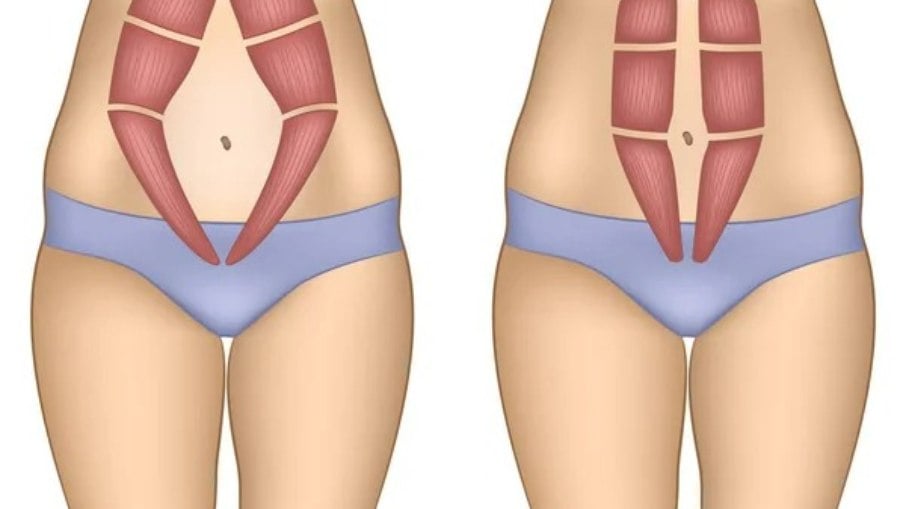 Ilustração mostra um dos tipos de diástase abdominal