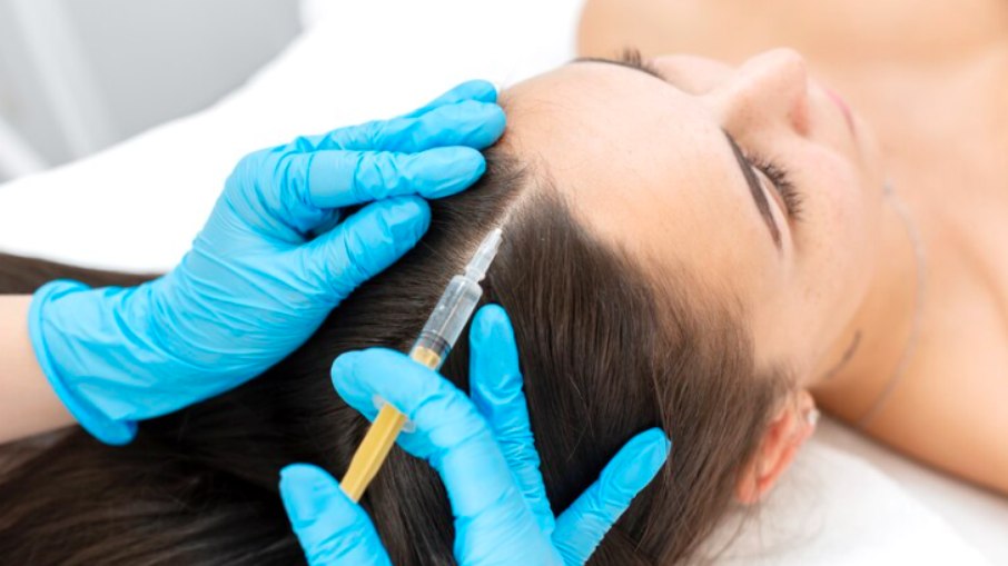 A mesoterapia capilar é um tratamento estético que envolve a aplicação de substâncias no couro cabeludo
