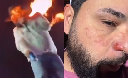 Após ser atingido por chamas, sertanejo Léo mostra queimaduras