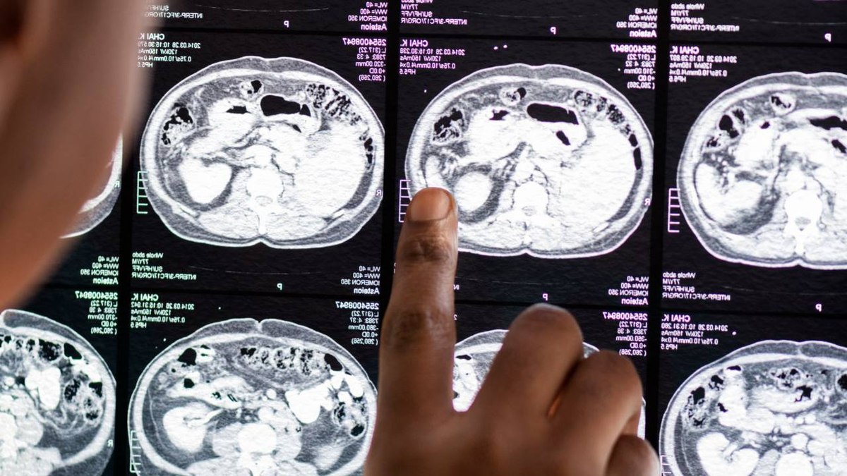 A doença afeta diferentes partes do corpo, incluindo olhos, a medula espinhal e o cérebro A doença afeta diferentes partes do corpo, incluindo olhos, a medula espinhal e o cérebro