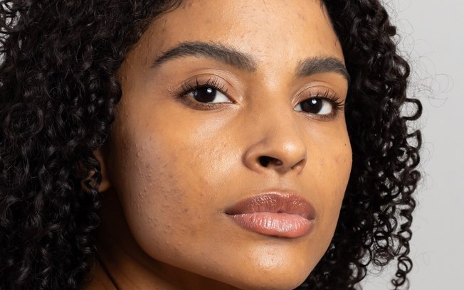Mês de Conscientização da Acne incentiva cuidados especiais