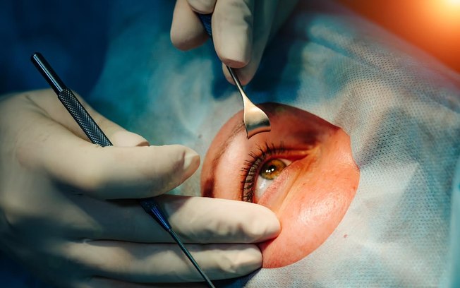 Cirurgia de catarata evolui e amplia recuperação da visão