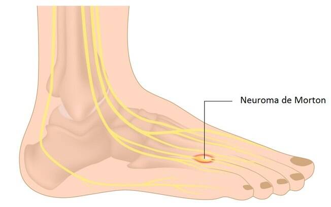 O neuroma de Morton causa intensas dores no pé afetado; condição pode ser evitada ao utilizar calçados apropriados