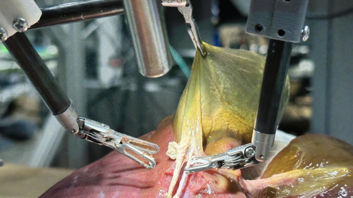 Robô realiza cirurgia em porco morto com tecnologia de vídeos e comandos de voz. Imagem ilustrativa de Robô realiza cirurgia em porco morto com tecnologia de vídeos e comandos de voz.