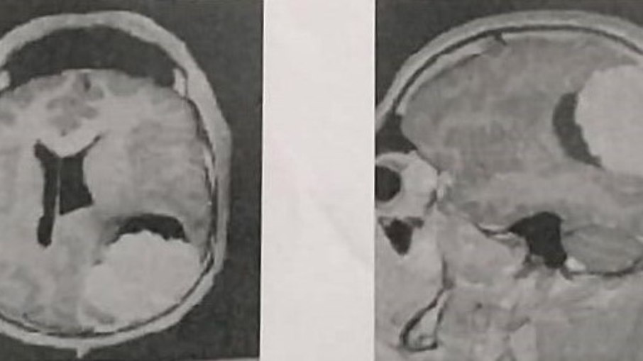 Tomografia de André Nery mostra o tumor intracraniano