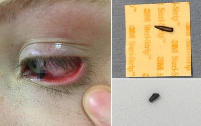 A menina, que mora na Inglaterra, foi atingida no olho direito por um lápis, ficou com pedaços dentro e passou por operação