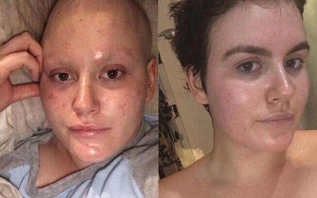 A australiana Bianca Innes foi diagnosticada com câncer de mama aos 20 anos após encontrar um nódulo na mama direita 